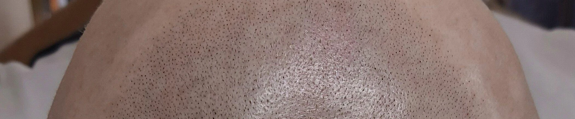 Trihoscalp