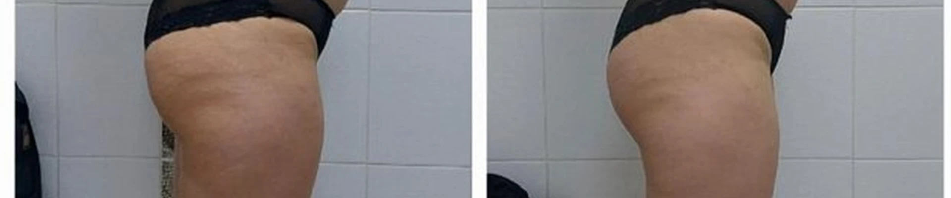 Lpg slim body в Комсомольске-на-амуре Советская улица, 12