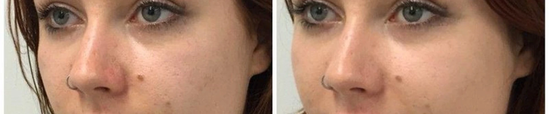 Allfillers