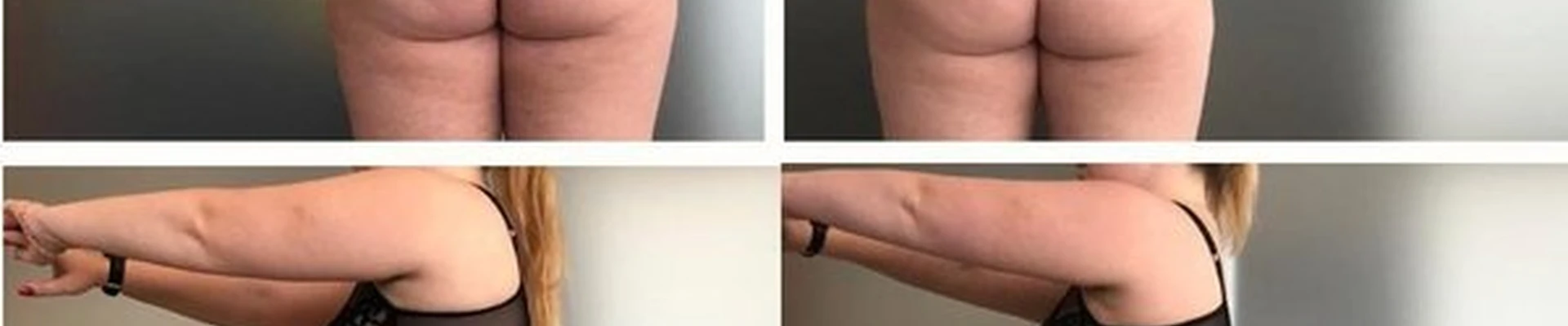 Laser skin