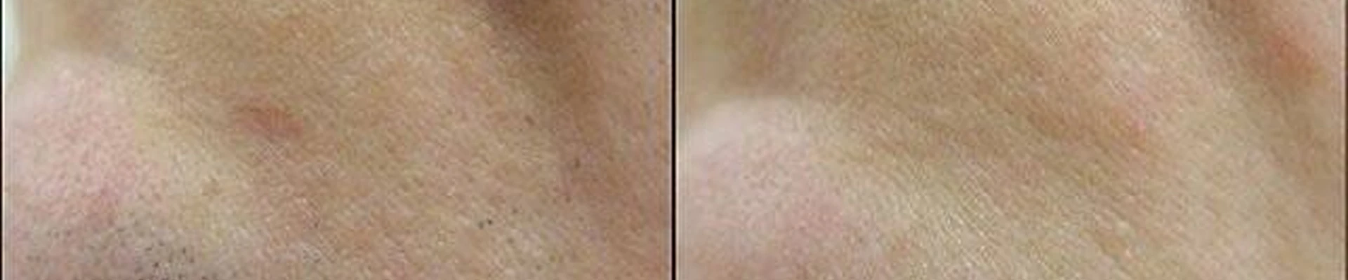 Beauty innovatione epil