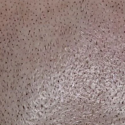 Trihoscalp