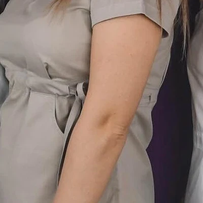 Epilazer_pro